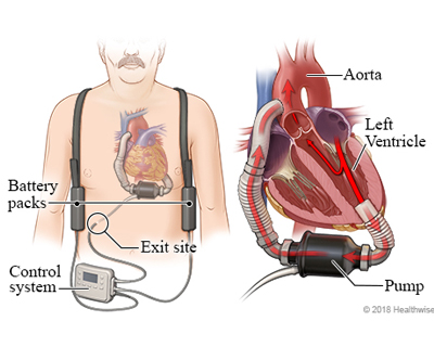 Left Ventricular Assist Device